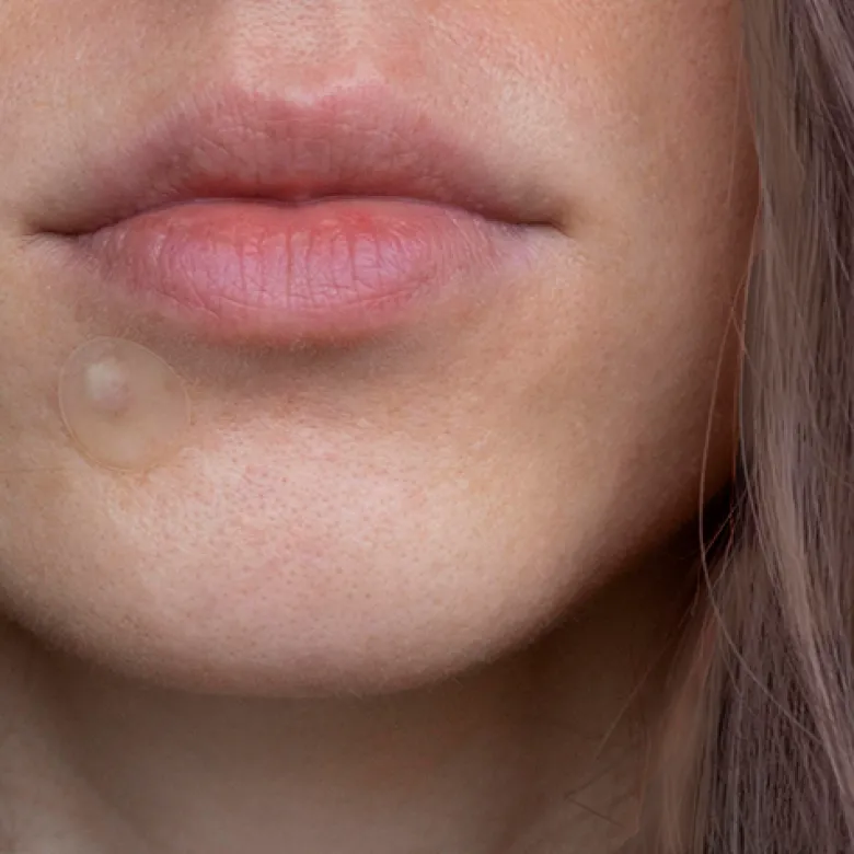 Australian Bodycare Pimple Patches (20 stk)