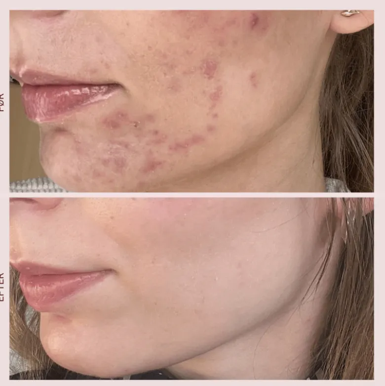 Pudderdåserne T-Zone Peeling (50 ml)