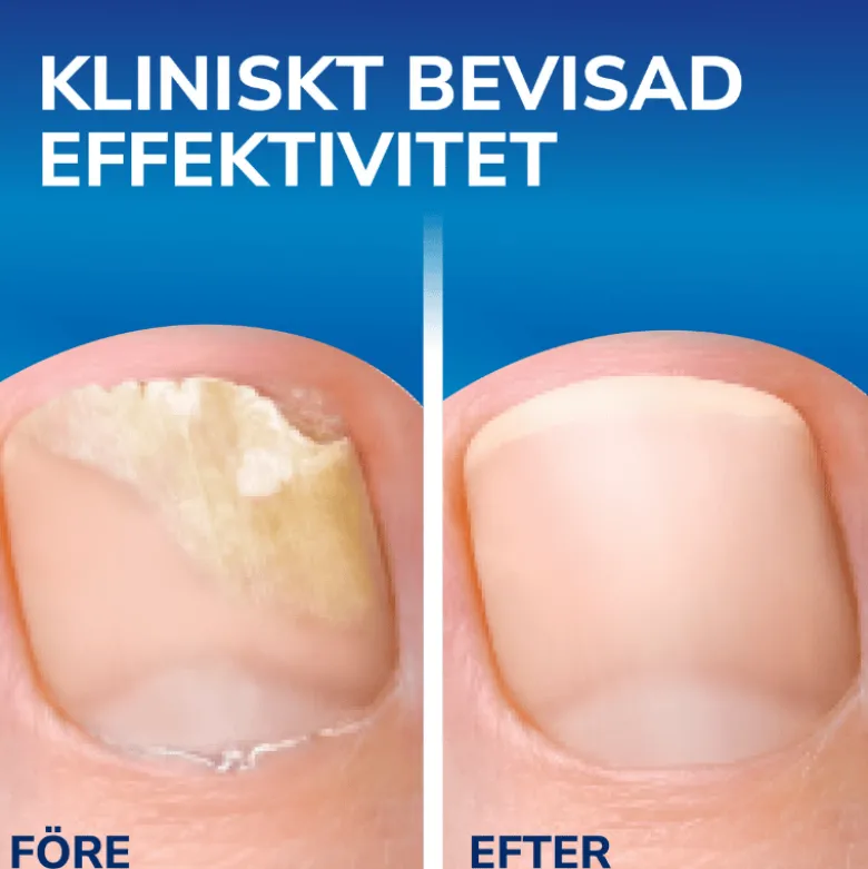 Scholl neglesvamp beh.(3,8 ml)